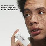 Super Balm Antiacne
